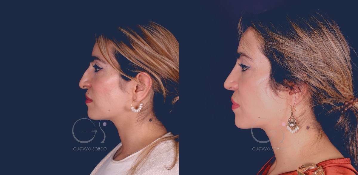 Perfil izquierdo. Antes de la cirugía y al año.
