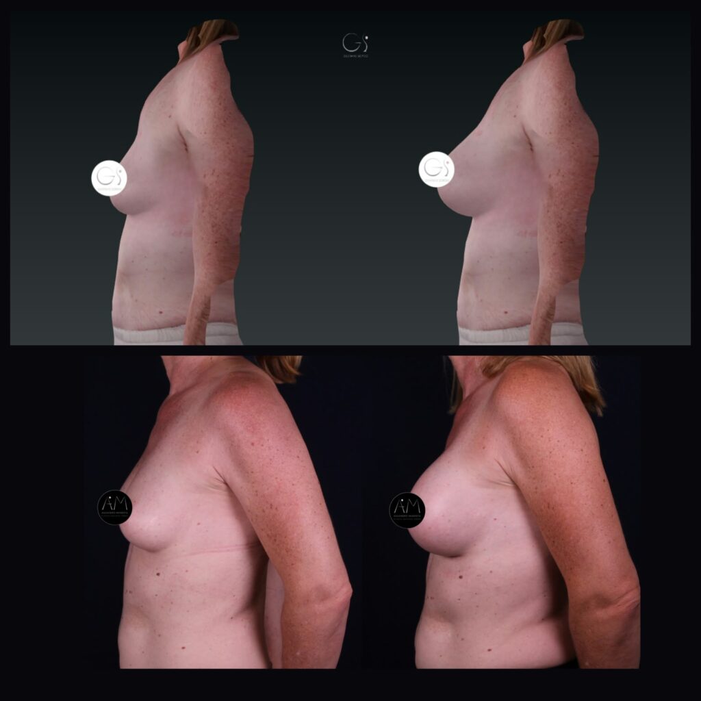 Breast augmentation with PRESERVÉ technique, profile view: 3D simulation with Crisalix above and actual result below