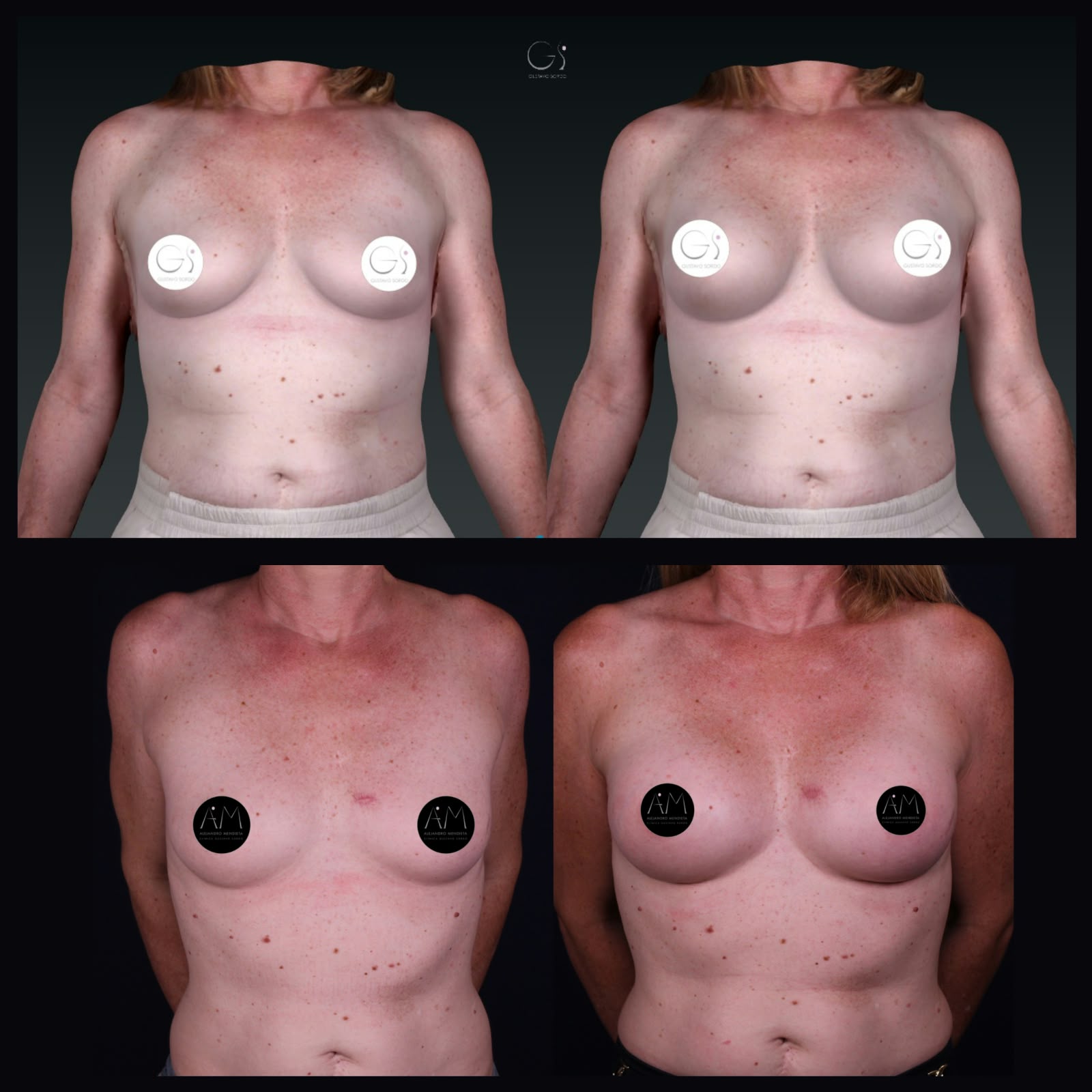 Aumento de pecho técnica Preservé — comparativa simulación 3D Crisalix y resultado real, vista frontal