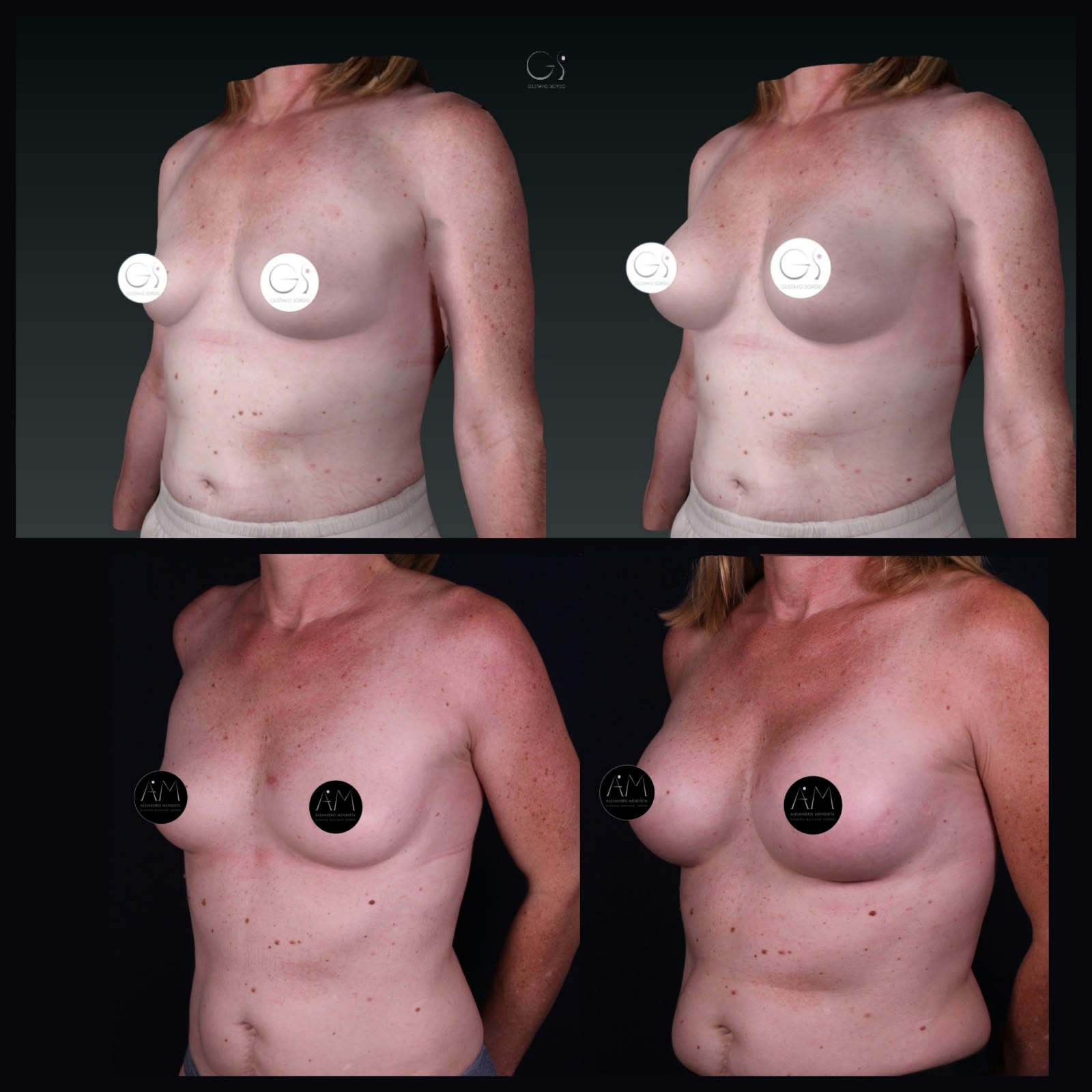 Aumento de pecho técnica Preservé — comparativa simulación 3D Crisalix y resultado real, vista oblicua