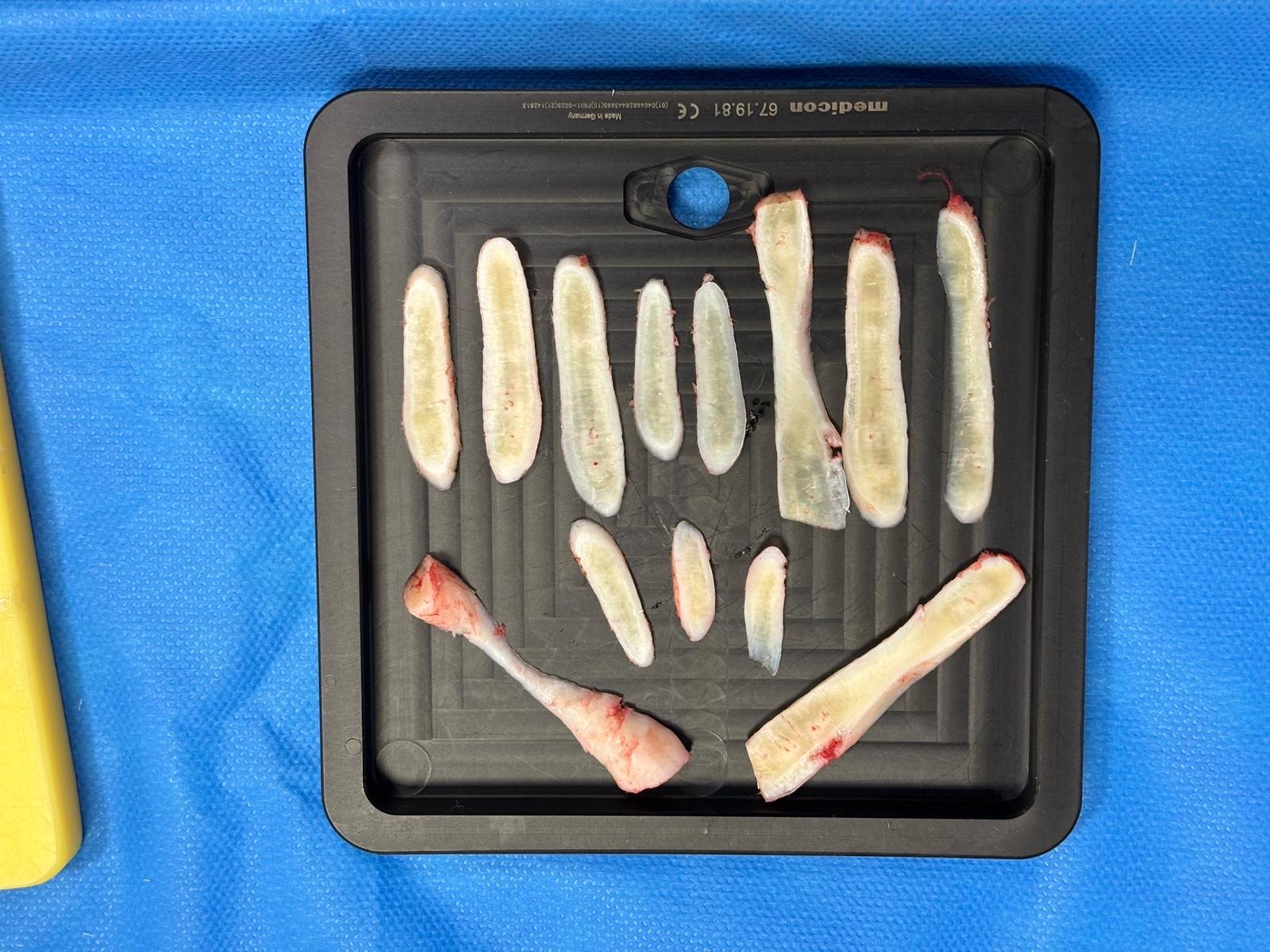 Injertos de cartílago costal tallados para una rinoplastia