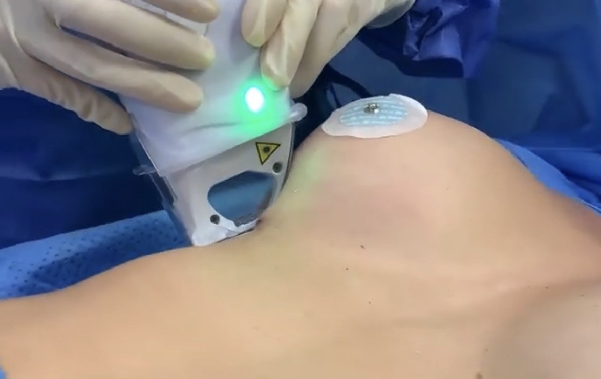 Aplicación del láser UrgoTouch sobre la mama al final de una cirugía de aumento de pecho, en quirófano