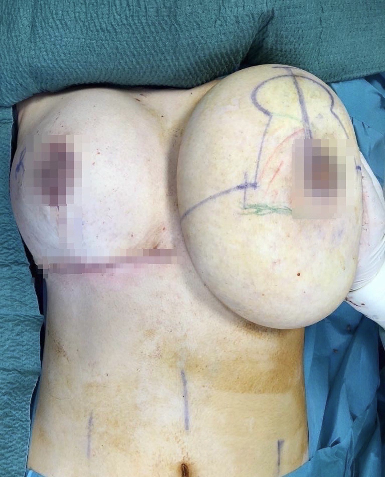 Marcado preoperatorio de una reducción de pecho en el quirófano de la clínica del Dr. Gustavo Sordo