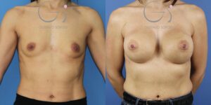 Aumento de pecho con implantes anatómicos de 545 cc en una paciente con pectus excavatum: antes (izquierda) y después (derecha). Caso operado por el Dr. Gustavo Sordo en Madrid.