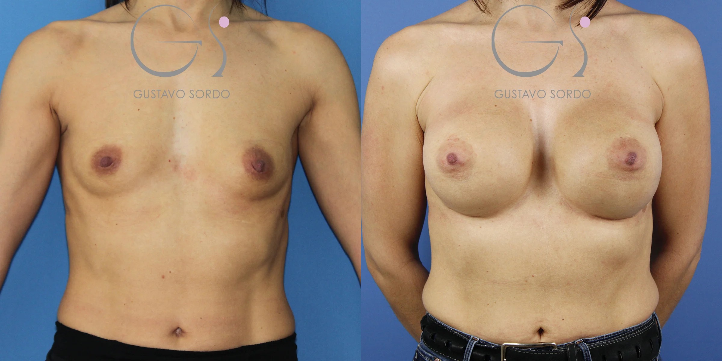 Aumento de pecho con implantes anatómicos de 545 cc en una paciente con pectus excavatum: antes (izquierda) y después (derecha). Caso operado por el Dr. Gustavo Sordo en Madrid.