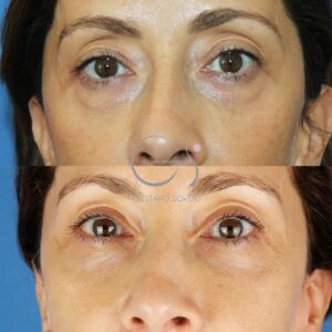 DOUBLE BLEPHAROPLASTY IN A 50-YEAR-OLD WOMAN