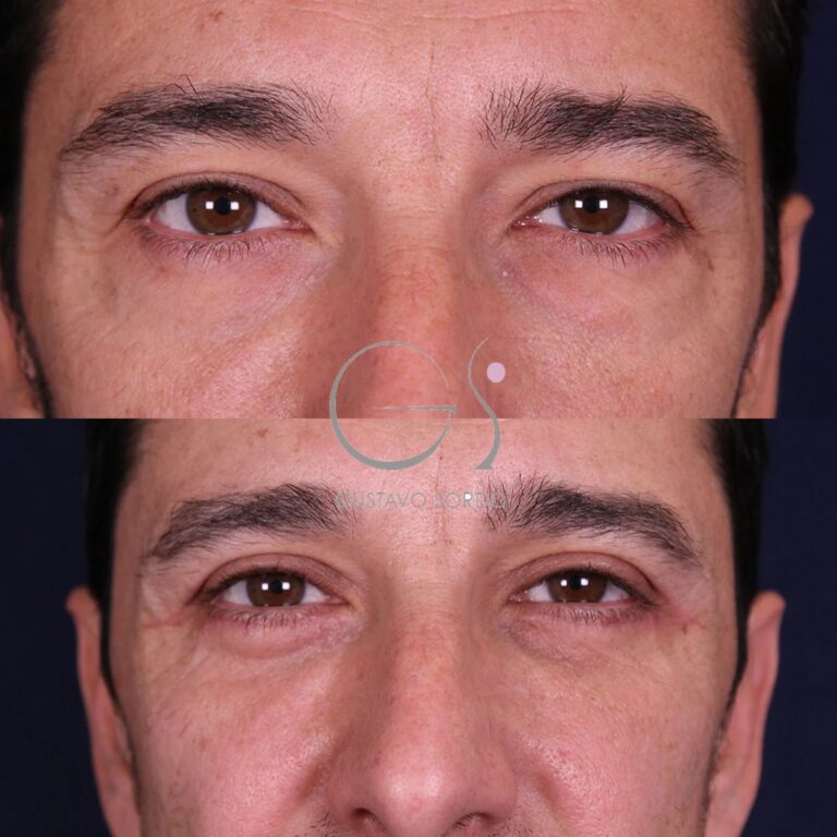 Blefaroplastia: antes y después de un caso operado en Madrid