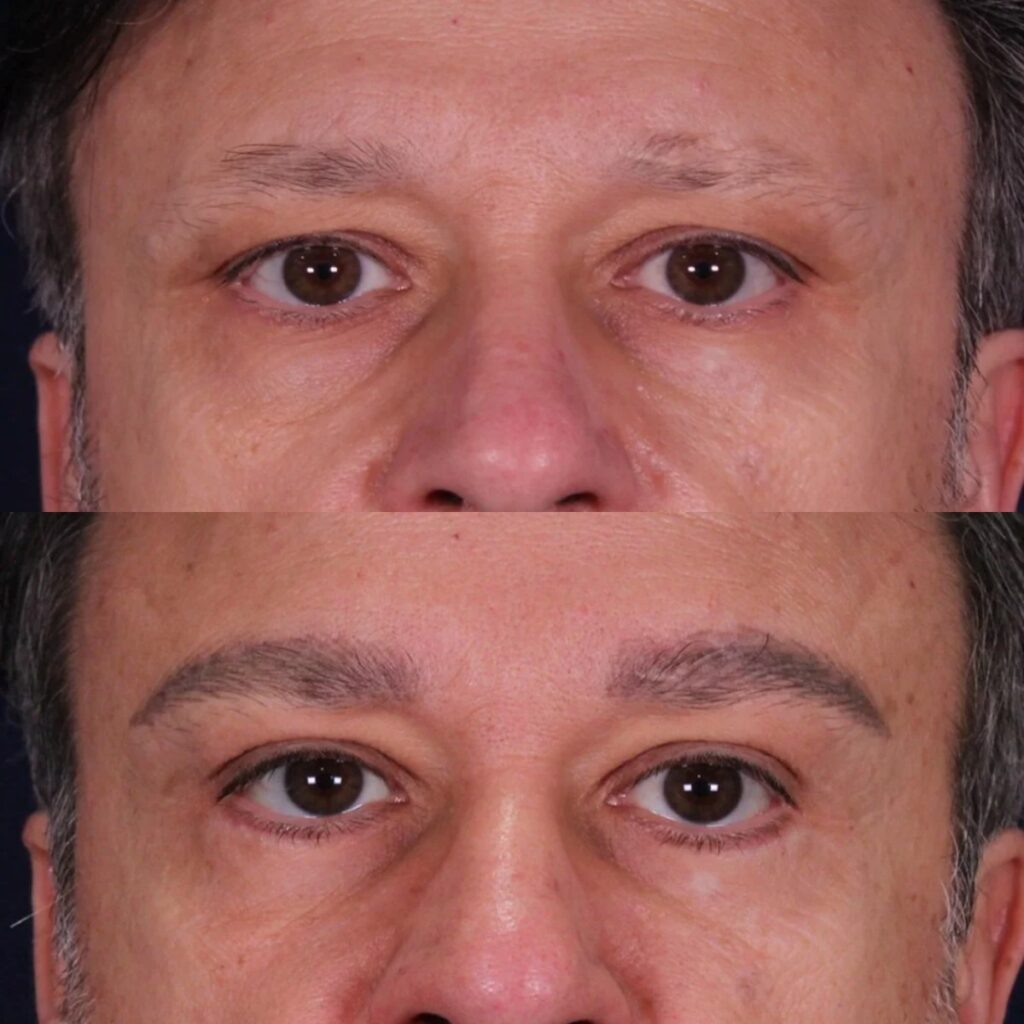 Blefaroplastia: antes y después de un caso operado en Madrid