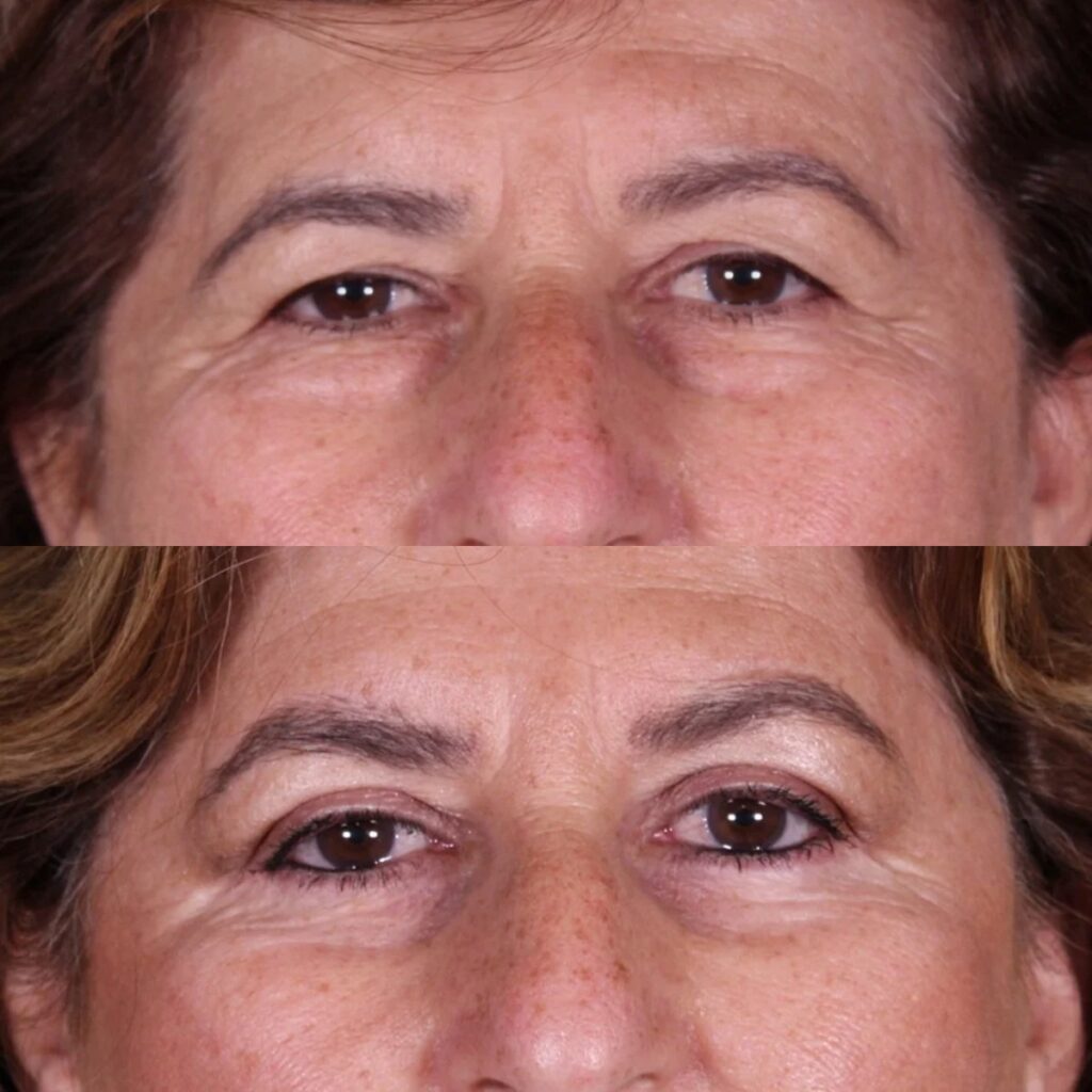 Blefaroplastia: antes y después de un caso operado en Madrid
