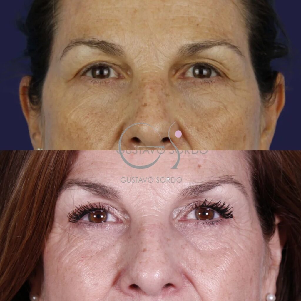 Blefaroplastia: antes y después de un caso operado en Madrid