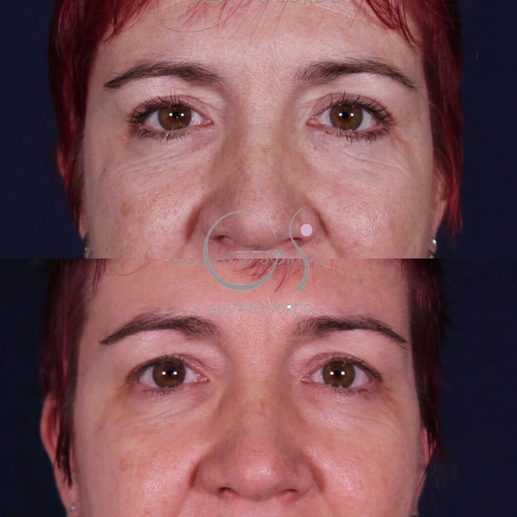 Blefaroplastia: antes y después de un caso operado en Madrid