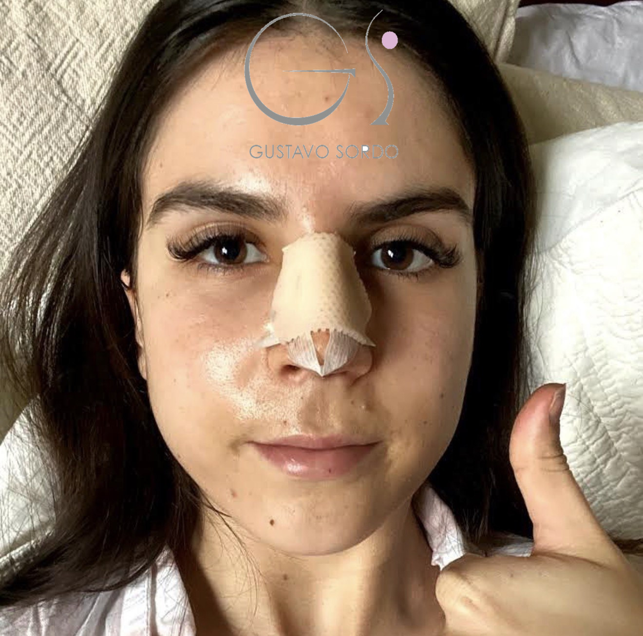 Paciente a los siete días de una rinoplastia ultrasónica, con la férula nasal todavía puesta y sin moratones alrededor de los ojos