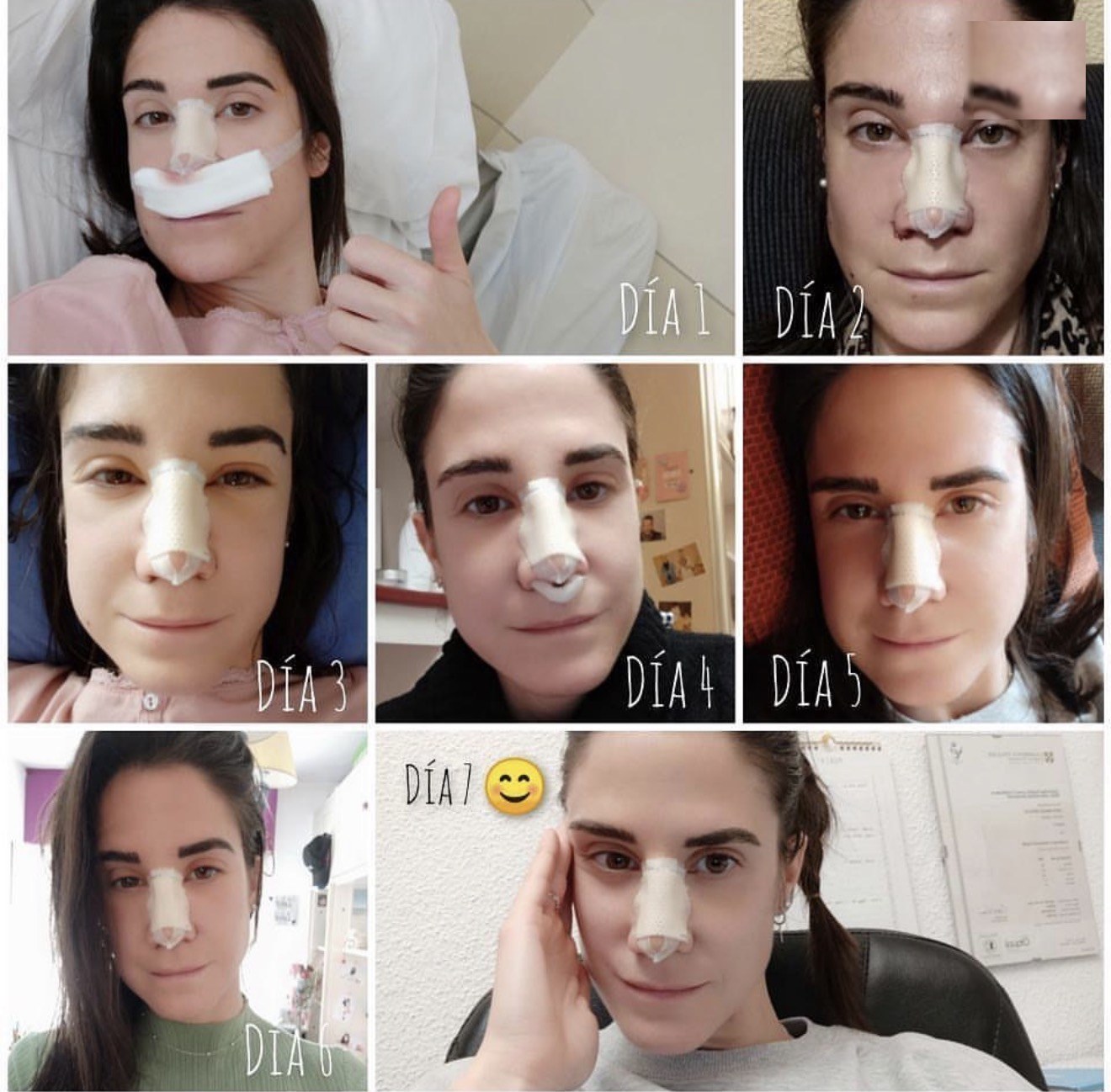 Recuperación día a día de una paciente real tras una rinoplastia ultrasónica: del día 1 al día 7, sin moratones