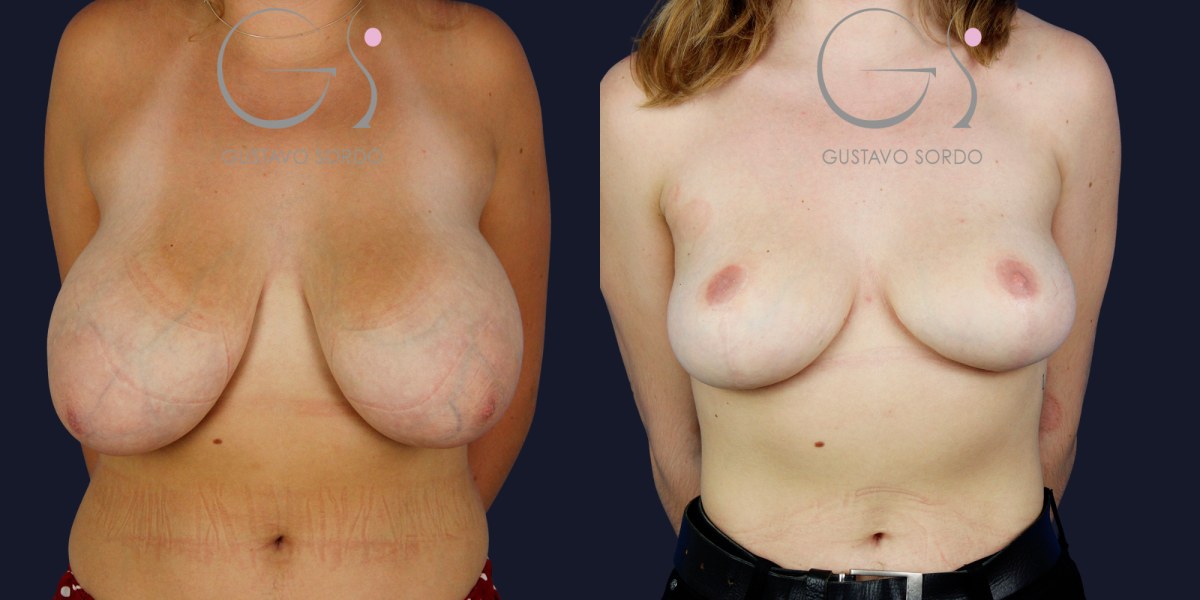 Reducción de areola: antes y después de un caso operado por el Dr. Gustavo Sordo en Madrid