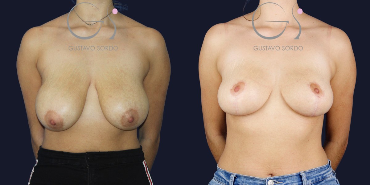 Reducción de areola: antes y después de un caso operado por el Dr. Gustavo Sordo en Madrid