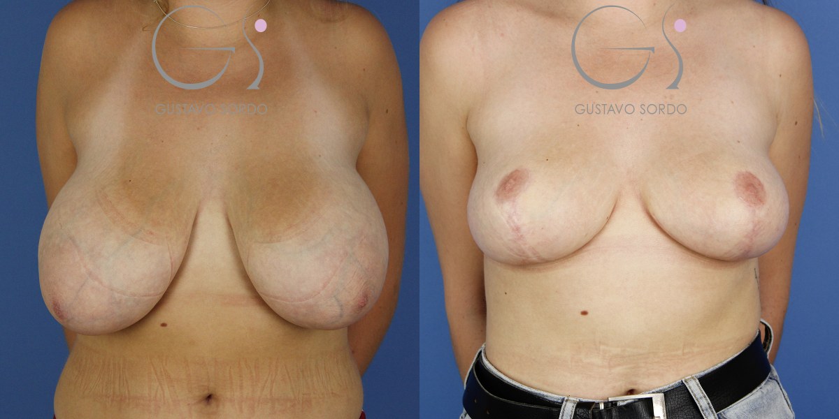 Reducción de areola: antes y después de un caso operado por el Dr. Gustavo Sordo en Madrid