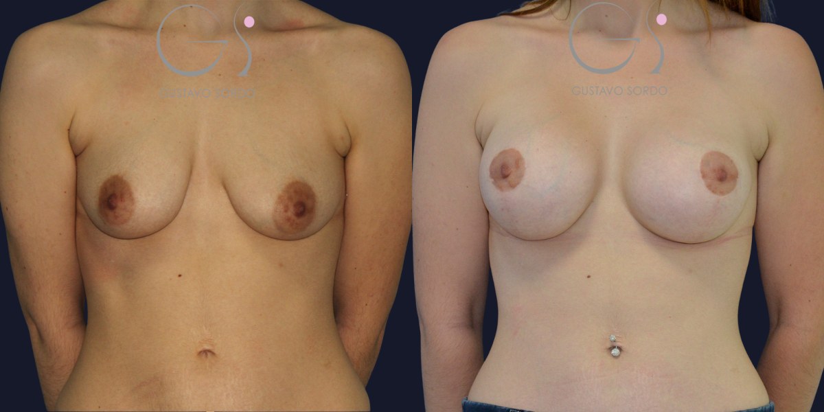 Reducción de areola: antes y después de un caso operado por el Dr. Gustavo Sordo en Madrid