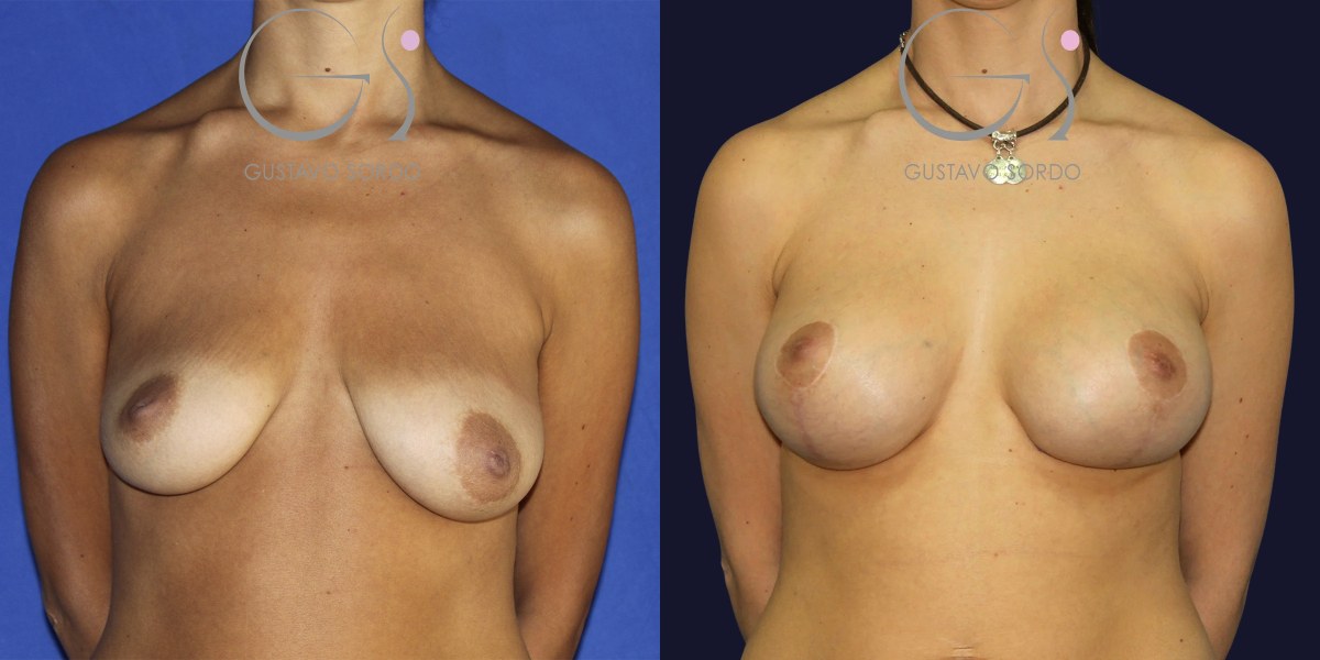 Reducción de areola: antes y después de un caso operado por el Dr. Gustavo Sordo en Madrid