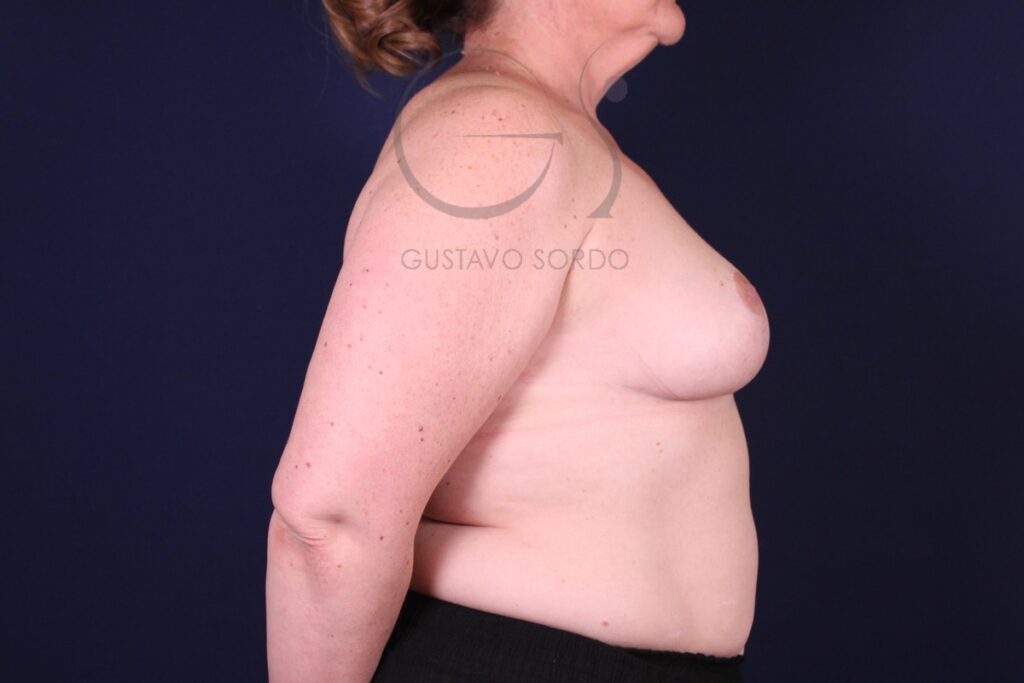 Reducción mamaria tras una pérdida de 24 kg: resultado a los 12 meses, de perfil. Caso operado por el Dr. Gustavo Sordo en Madrid