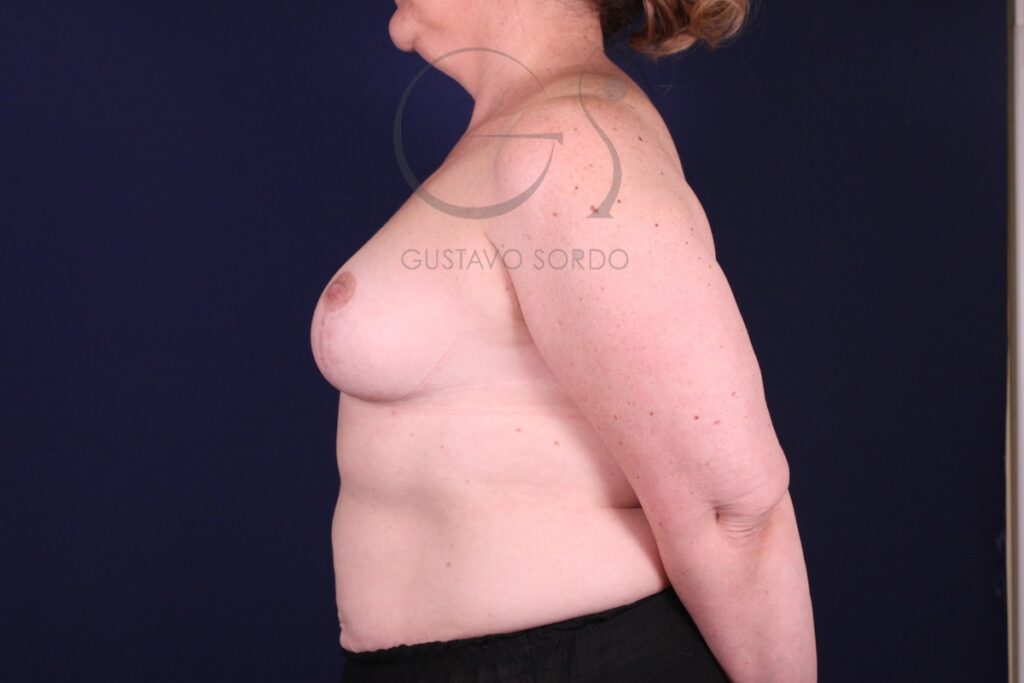 Reducción mamaria tras una pérdida de 24 kg: resultado a los 12 meses, de perfil, el otro lado. Caso operado por el Dr. Gustavo Sordo en Madrid