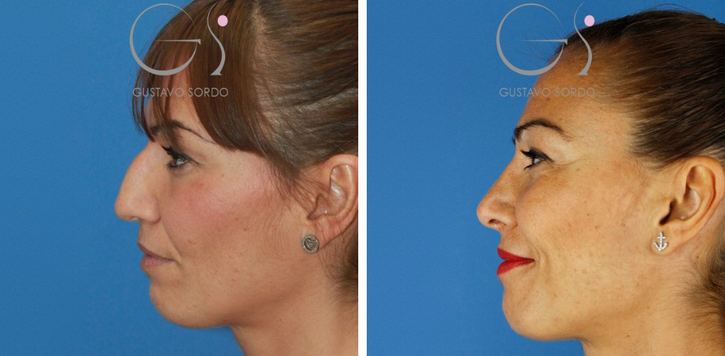 Rinoplastia ultrasónica de caballete y punta: antes y después de un caso operado en Madrid