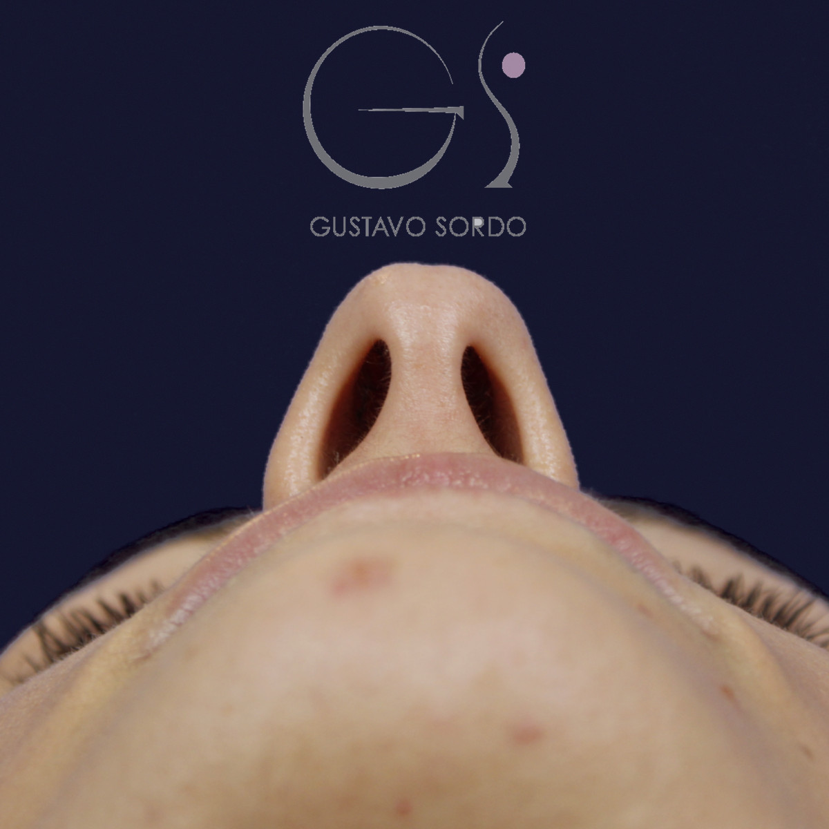 Rinoplastia en nariz aguileña con dorso en S y radix bajo, vista basal, antes de la cirugía — caso del Dr. Gustavo Sordo en Madrid