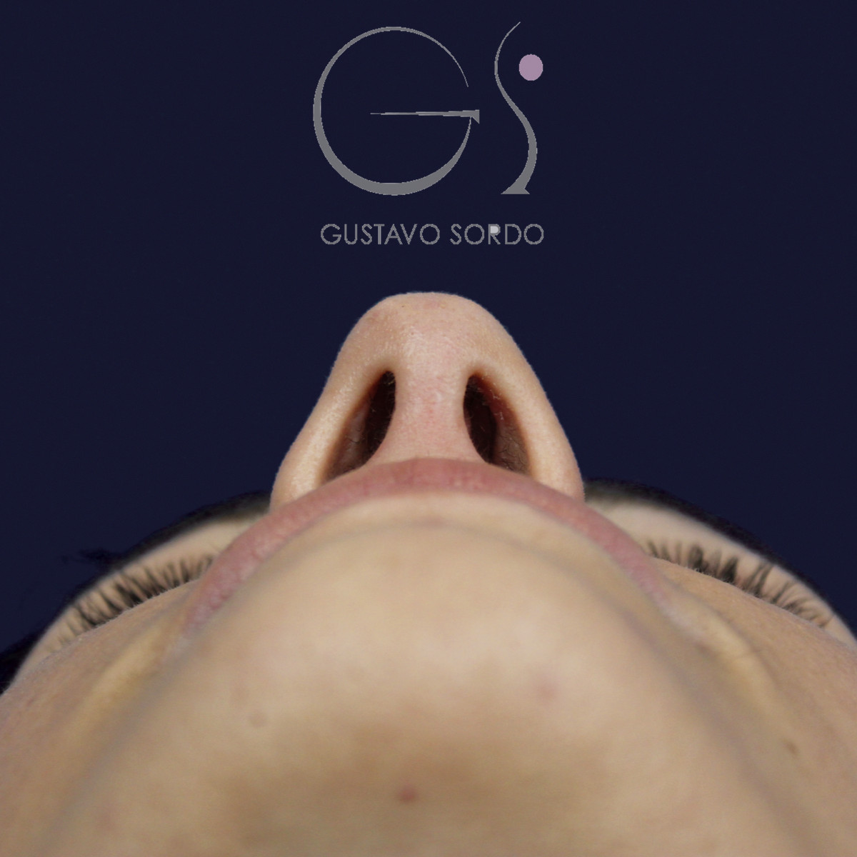 Rinoplastia en nariz aguileña con dorso en S y radix bajo, vista basal, al año de la cirugía — caso del Dr. Gustavo Sordo en Madrid