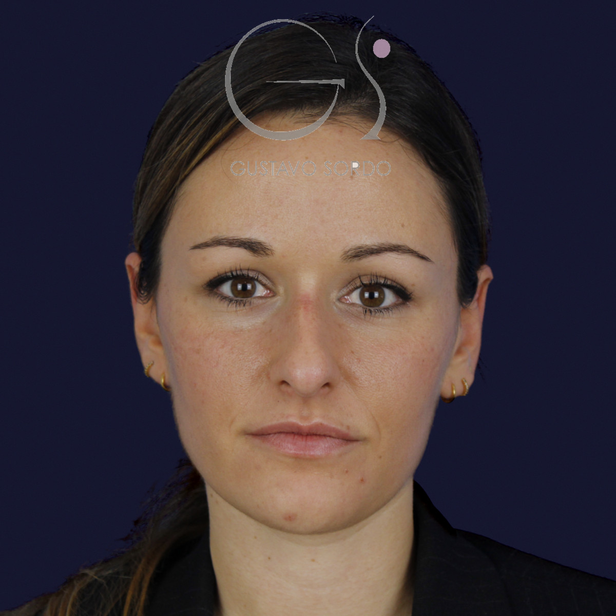 Rinoplastia en nariz aguileña con dorso en S y radix bajo, frontal, antes de la cirugía — caso del Dr. Gustavo Sordo en Madrid