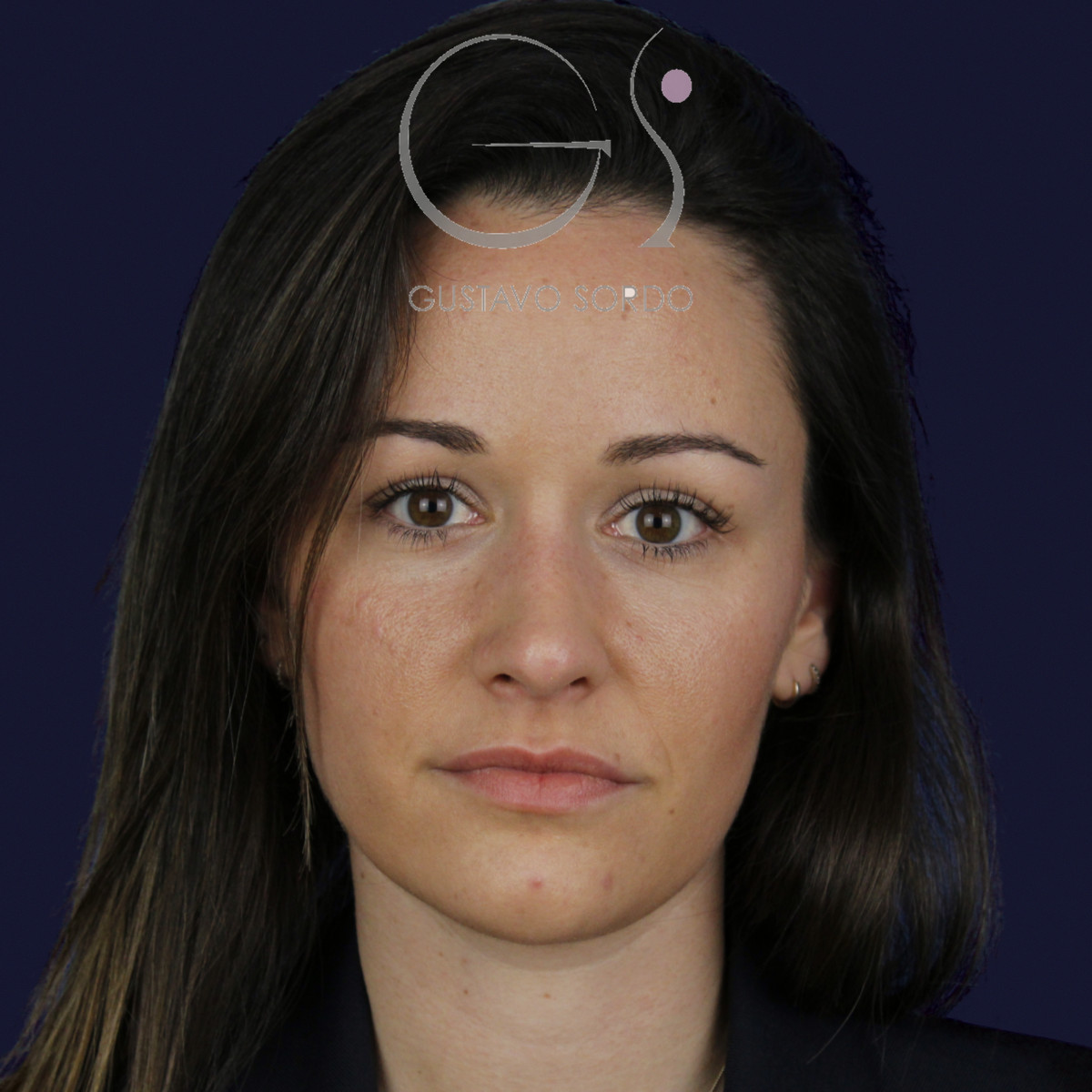Rinoplastia en nariz aguileña con dorso en S y radix bajo, frontal, al año de la cirugía — caso del Dr. Gustavo Sordo en Madrid