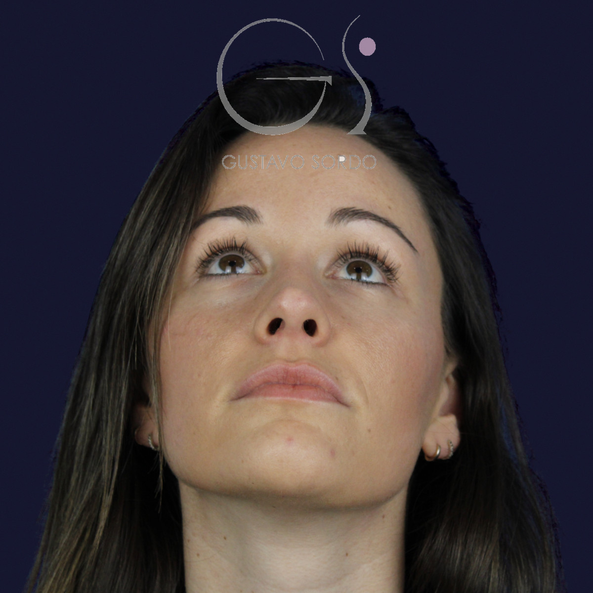 Rinoplastia en nariz aguileña con dorso en S y radix bajo, mentón arriba, al año de la cirugía — caso del Dr. Gustavo Sordo en Madrid