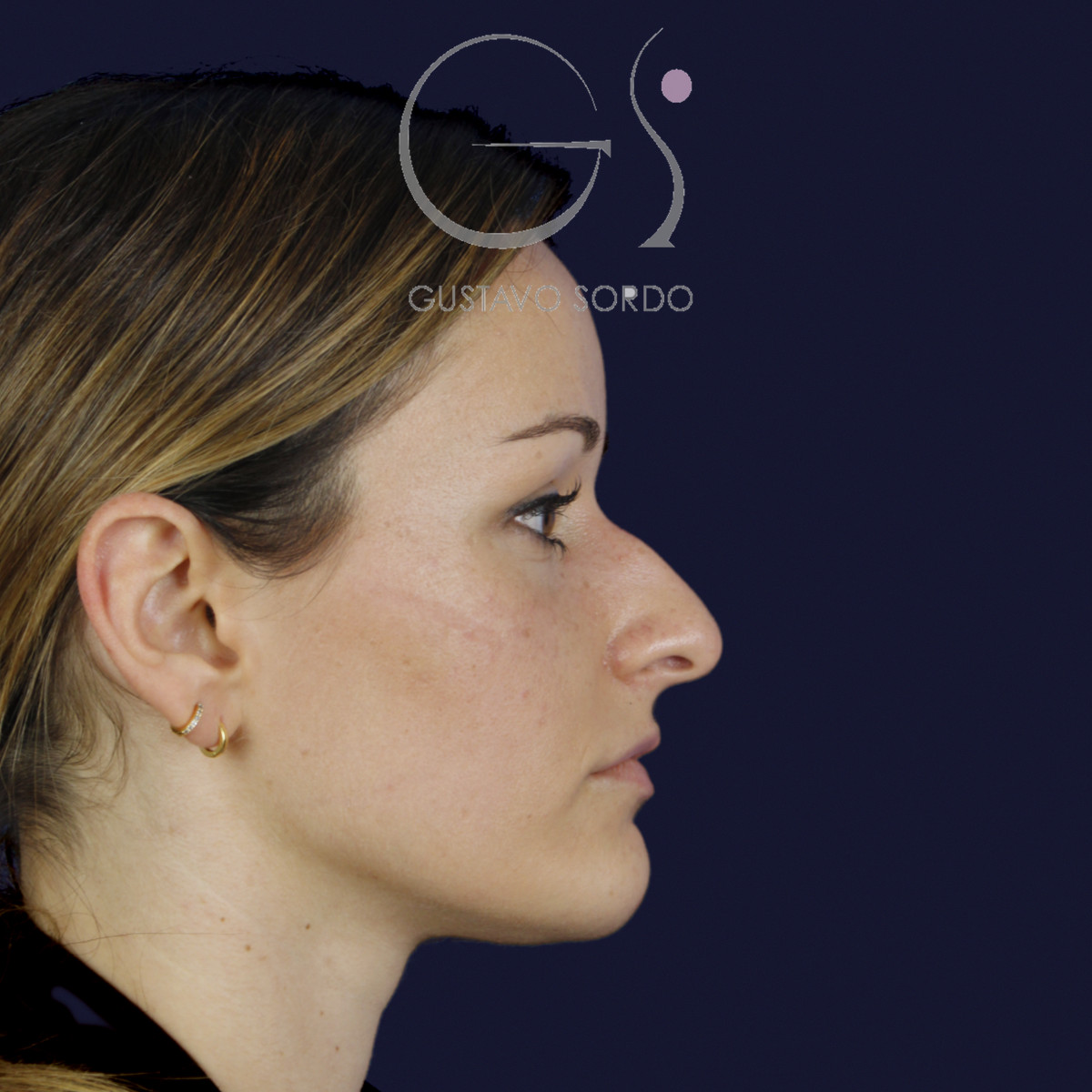 Rinoplastia en nariz aguileña con dorso en S y radix bajo, perfil derecho, antes de la cirugía — caso del Dr. Gustavo Sordo en Madrid