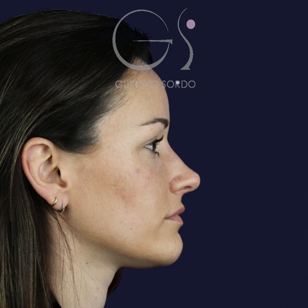 Rinoplastia en nariz aguileña con dorso en S y radix bajo, perfil derecho, al año de la cirugía — caso del Dr. Gustavo Sordo en Madrid