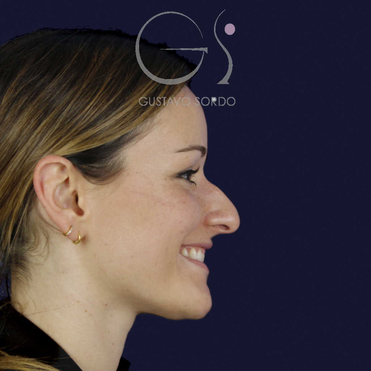 Rinoplastia en nariz aguileña con dorso en S y radix bajo, perfil derecho sonriendo, antes de la cirugía — caso del Dr. Gustavo Sordo en Madrid