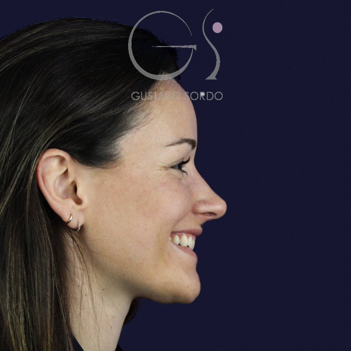 Rinoplastia en nariz aguileña con dorso en S y radix bajo, perfil derecho sonriendo, al año de la cirugía — caso del Dr. Gustavo Sordo en Madrid