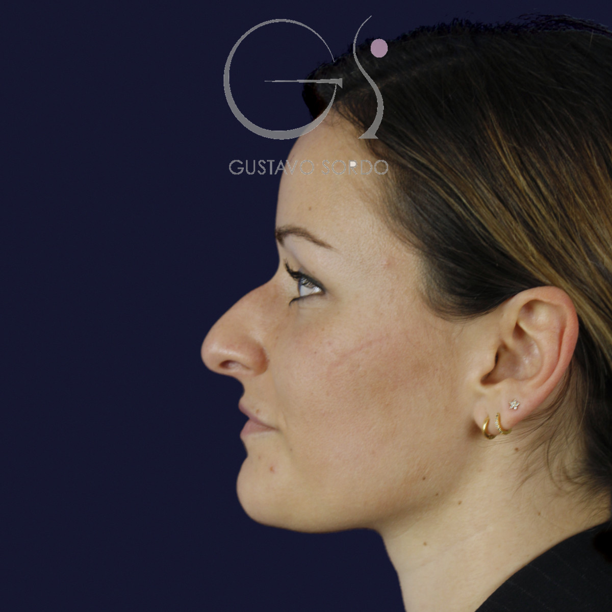 Rinoplastia en nariz aguileña con dorso en S y radix bajo, perfil izquierdo, antes de la cirugía — caso del Dr. Gustavo Sordo en Madrid