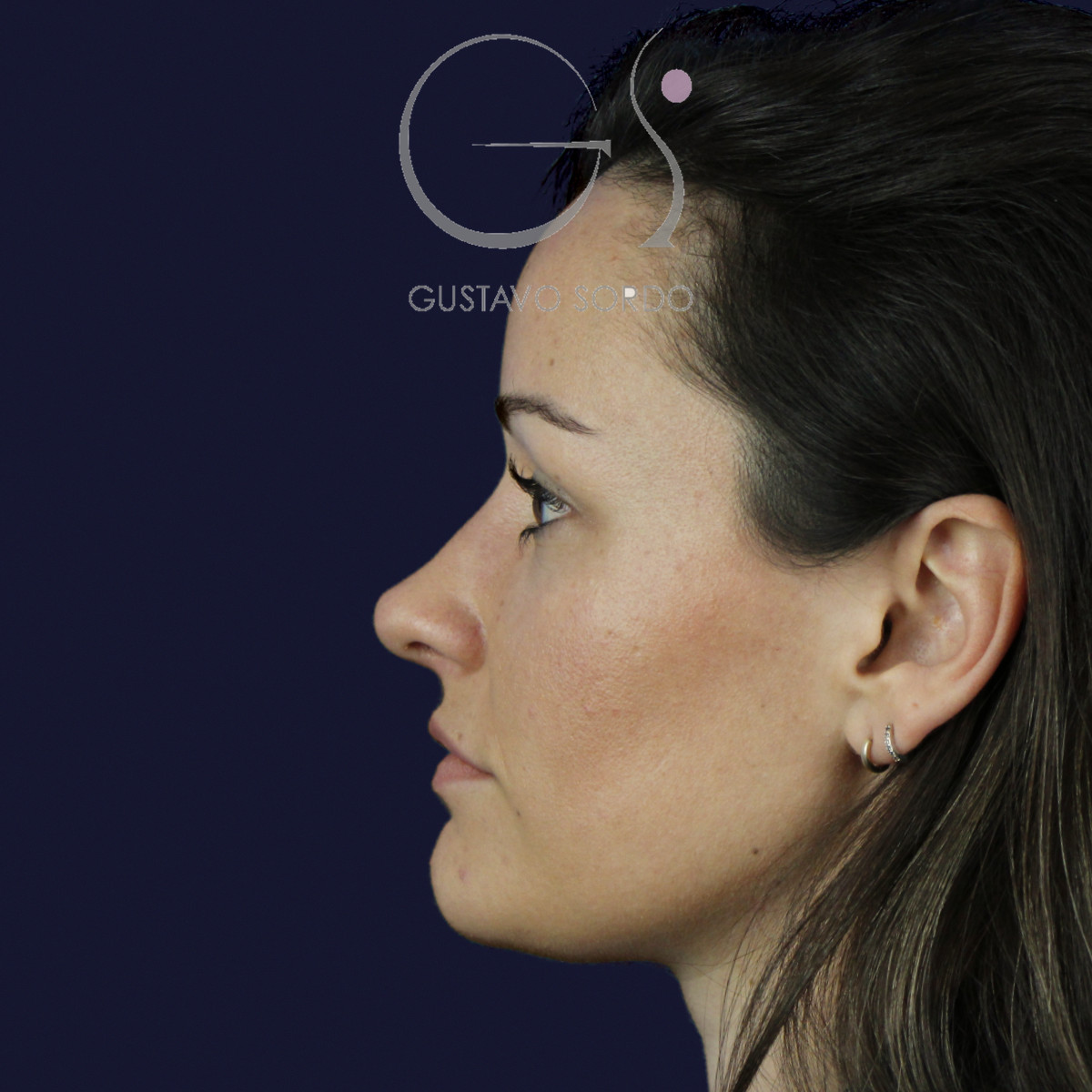 Rinoplastia en nariz aguileña con dorso en S y radix bajo, perfil izquierdo, al año de la cirugía — caso del Dr. Gustavo Sordo en Madrid