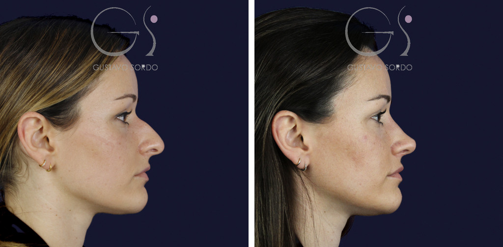 Rinoplastia en nariz aguileña con dorso en S y radix bajo: perfil derecho antes y al año — caso del Dr. Gustavo Sordo en Madrid