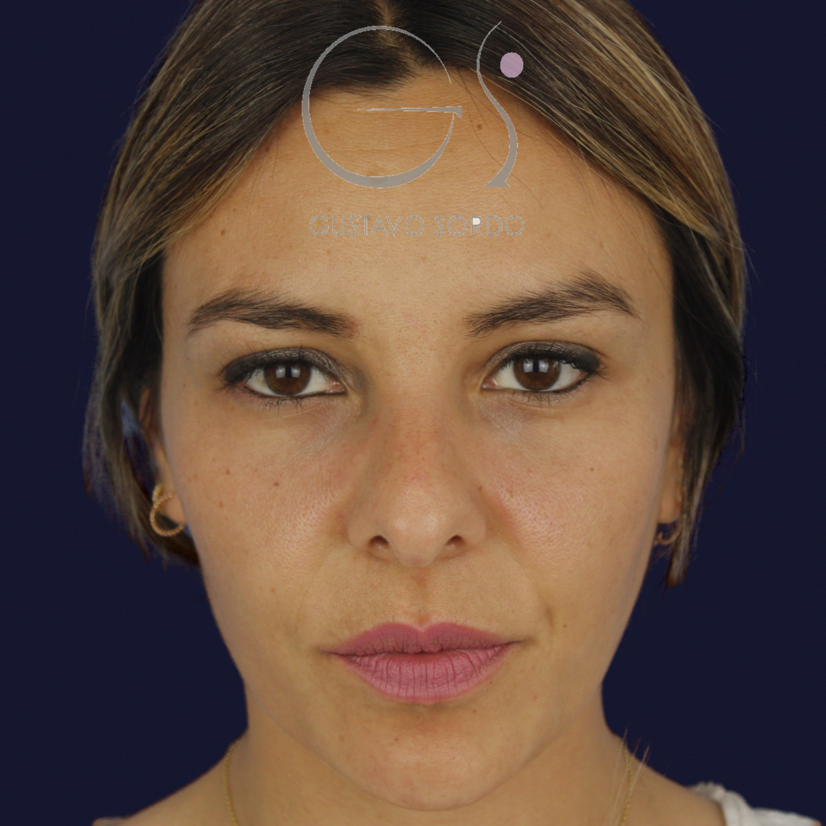 Rinoplastia y eliminación del caballete, vista frontal, antes de la cirugía — caso del Dr. Gustavo Sordo en Madrid