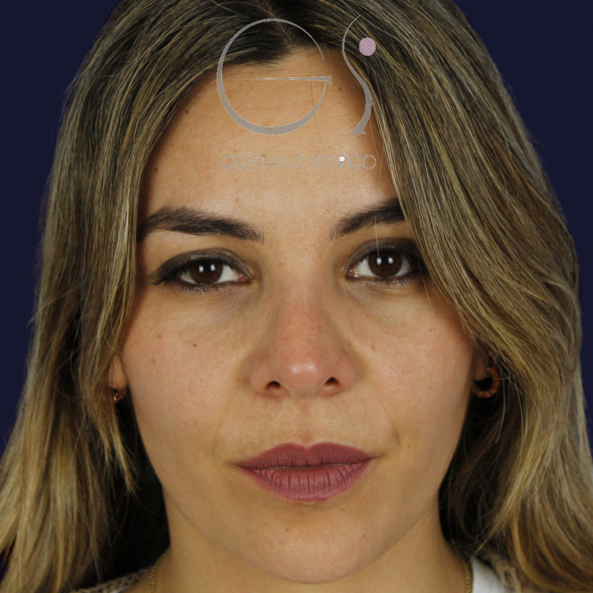Rinoplastia y eliminación del caballete, vista frontal, a los 7 meses de la cirugía — caso del Dr. Gustavo Sordo en Madrid