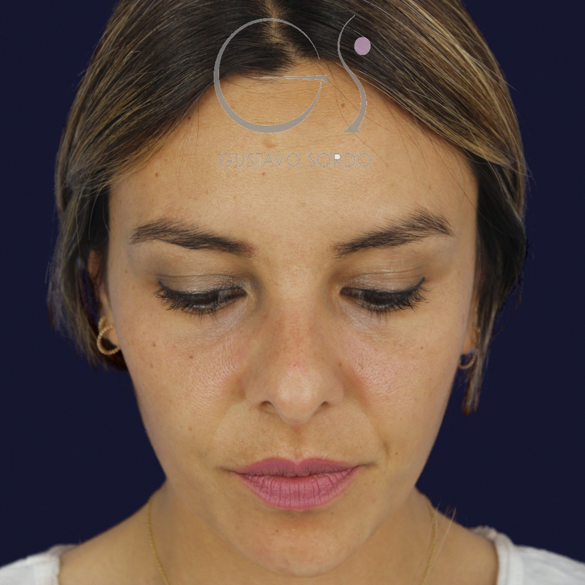 Rinoplastia y eliminación del caballete, mentón abajo, antes de la cirugía — caso del Dr. Gustavo Sordo en Madrid