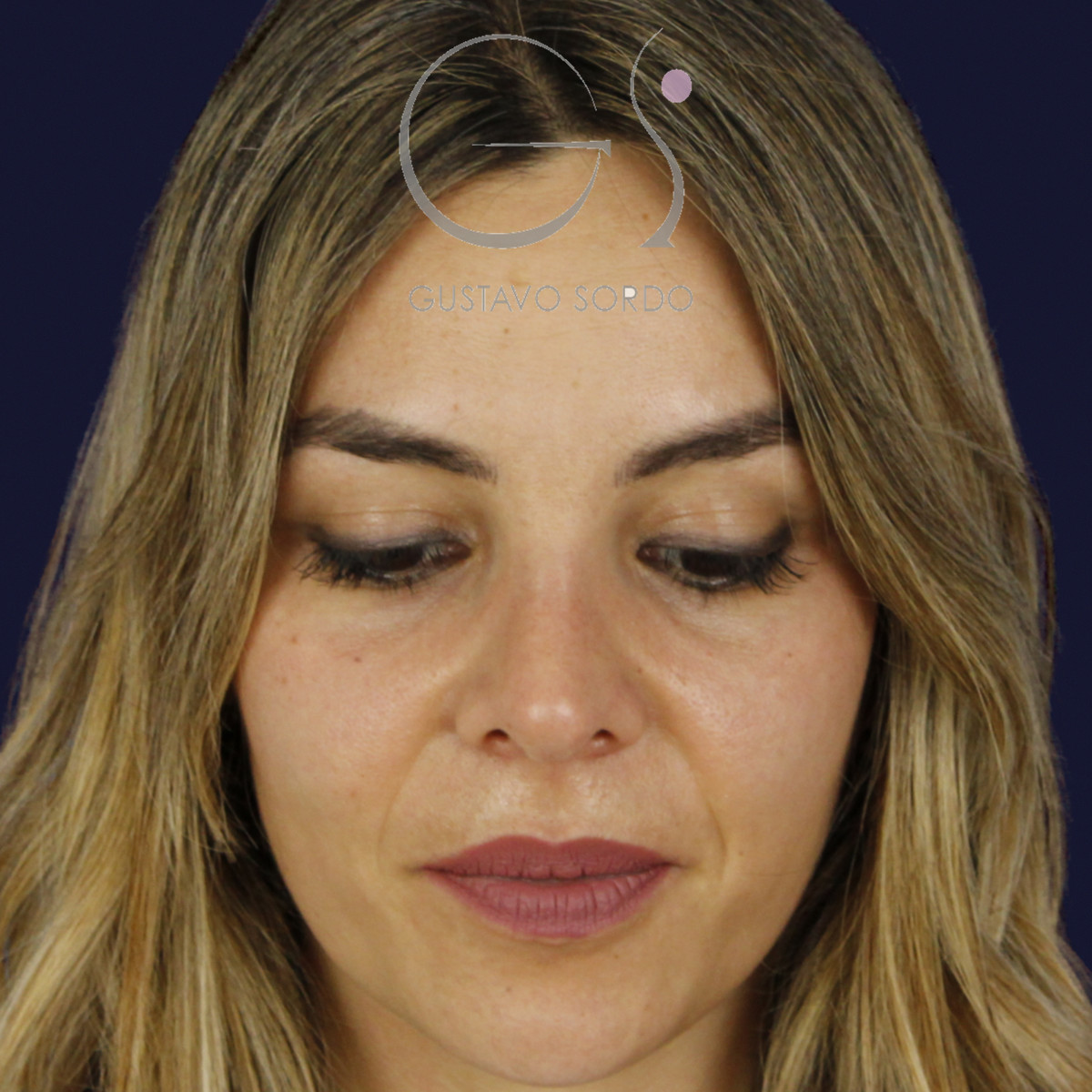 Rinoplastia y eliminación del caballete, mentón abajo, a los 7 meses de la cirugía — caso del Dr. Gustavo Sordo en Madrid
