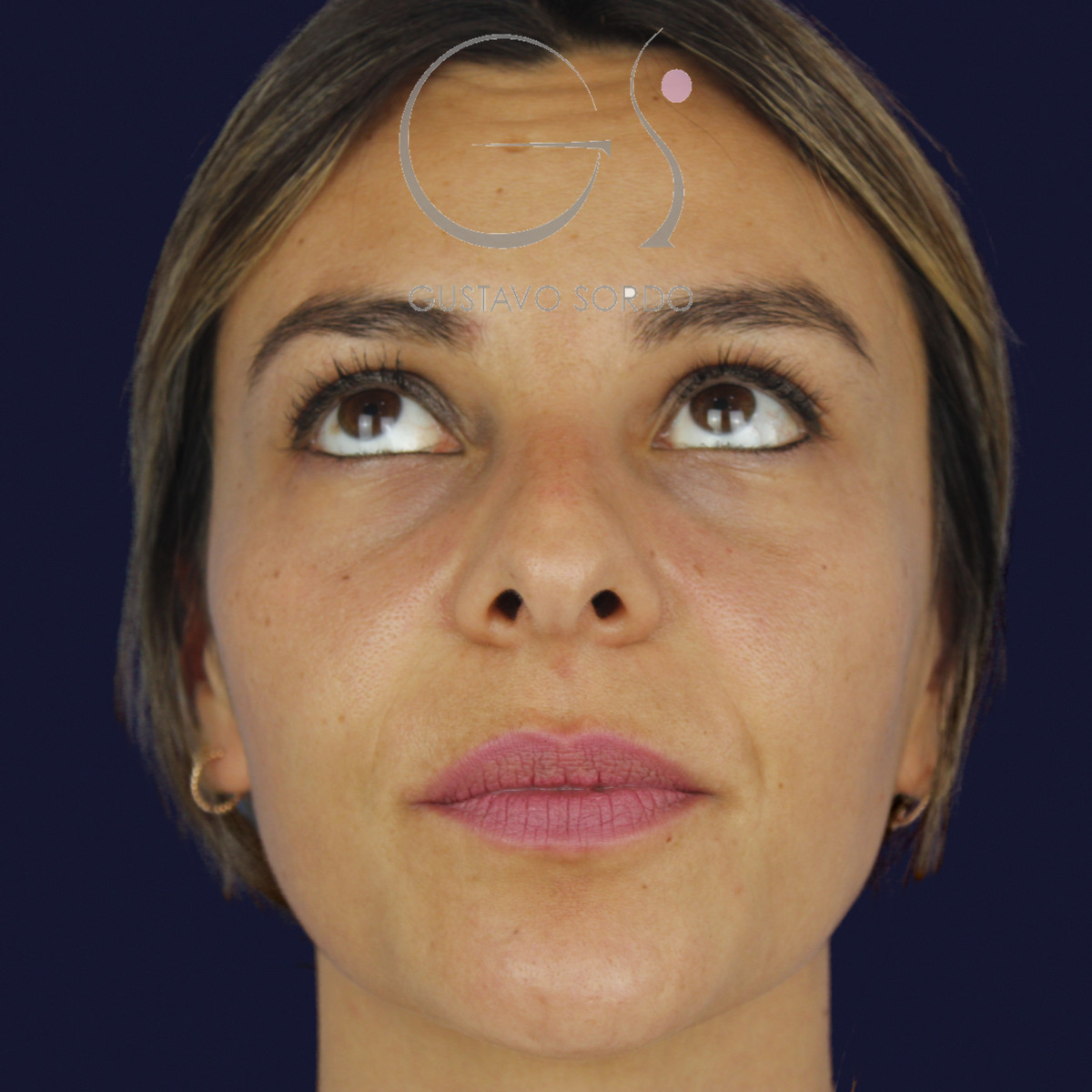 Rinoplastia y eliminación del caballete, mentón arriba, antes de la cirugía — caso del Dr. Gustavo Sordo en Madrid