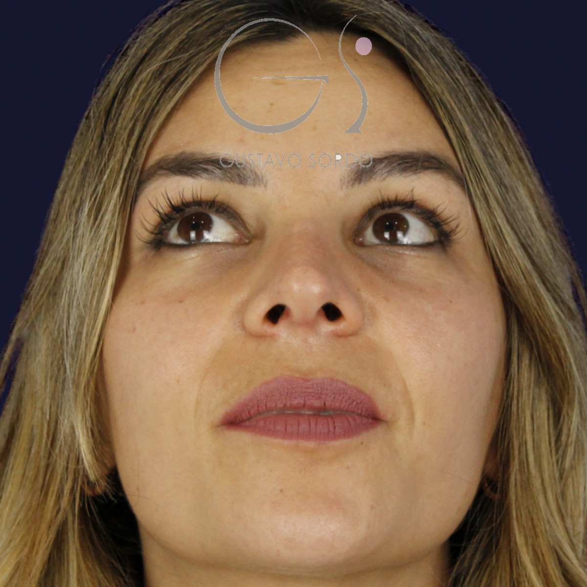 Rinoplastia y eliminación del caballete, mentón arriba, a los 7 meses de la cirugía — caso del Dr. Gustavo Sordo en Madrid