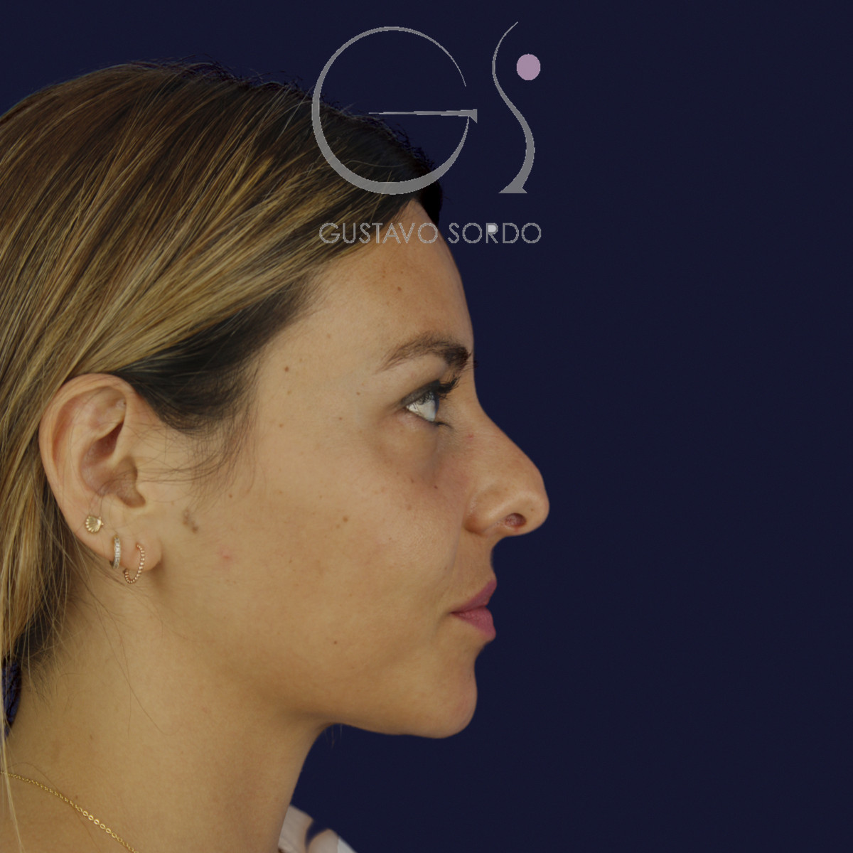 Rinoplastia y eliminación del caballete, perfil derecho, antes de la cirugía — caso del Dr. Gustavo Sordo en Madrid