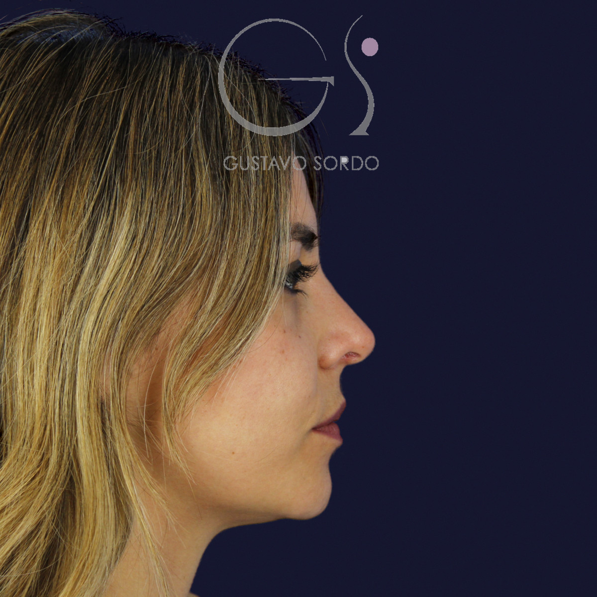 Rinoplastia y eliminación del caballete, perfil derecho, a los 7 meses de la cirugía — caso del Dr. Gustavo Sordo en Madrid