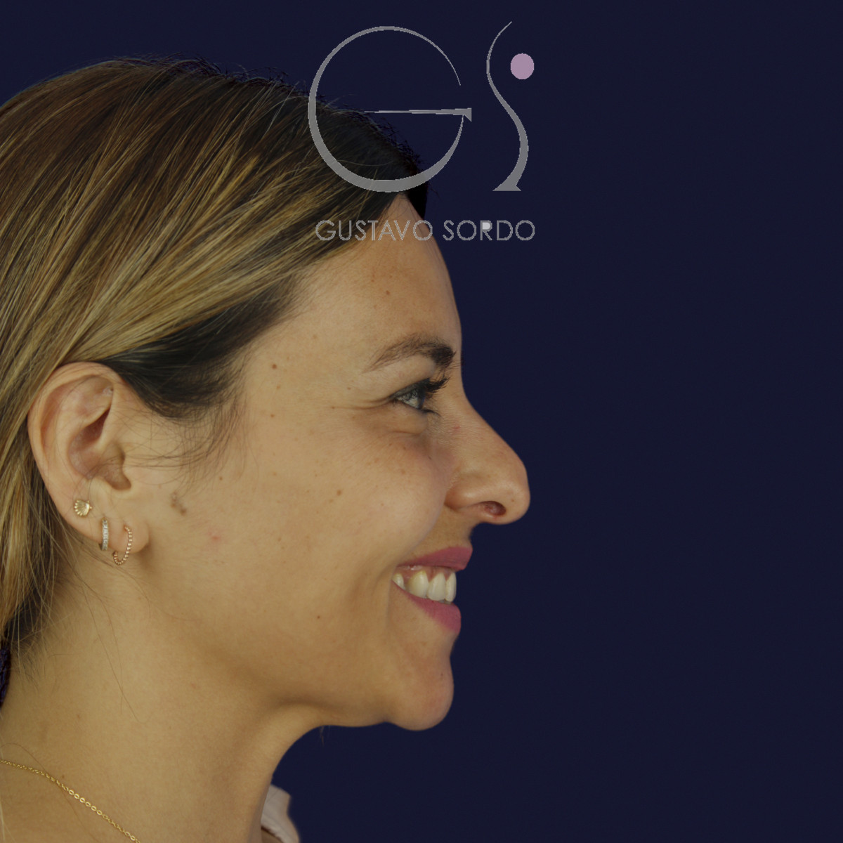 Rinoplastia y eliminación del caballete, perfil derecho sonriendo, antes de la cirugía — caso del Dr. Gustavo Sordo en Madrid