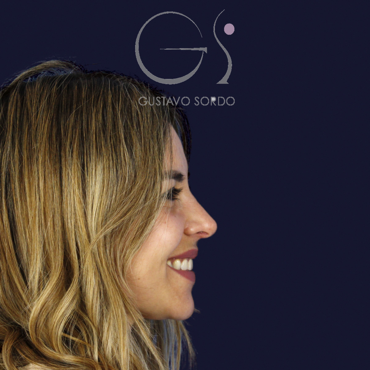 Antes y después rinoplastia ultrasónica de caballete dorsal, Dr. Gustavo Sordo, Madrid