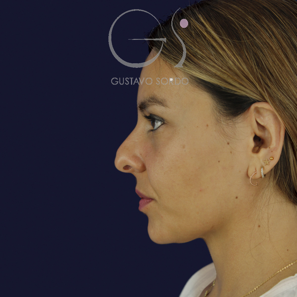 Rinoplastia y eliminación del caballete, perfil izquierdo, antes de la cirugía — caso del Dr. Gustavo Sordo en Madrid
