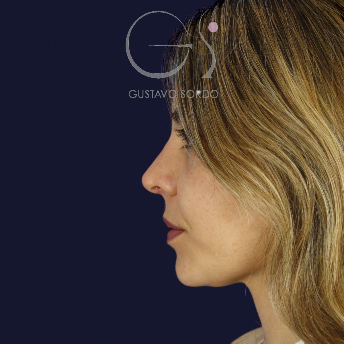 Rinoplastia y eliminación del caballete, perfil izquierdo, a los 7 meses de la cirugía — caso del Dr. Gustavo Sordo en Madrid