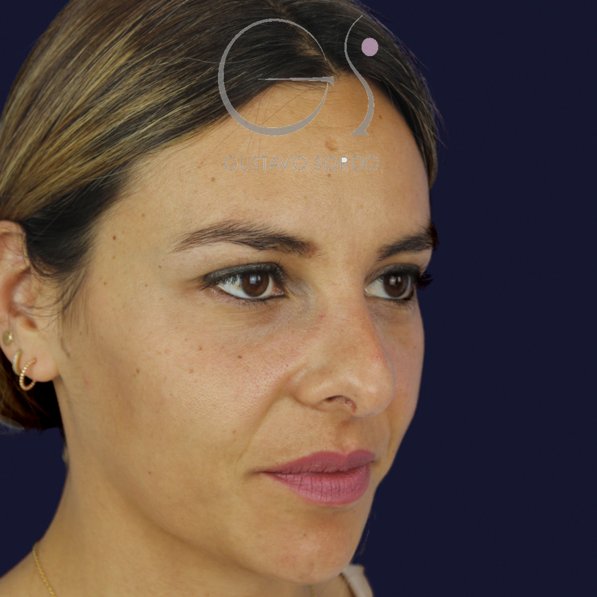 Rinoplastia y eliminación del caballete, semiperfil derecho, antes de la cirugía — caso del Dr. Gustavo Sordo en Madrid